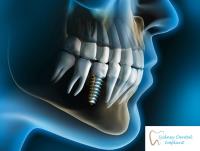 Sydney Dental Implant image 2